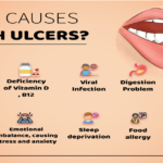 Mouth Ulcer Causes