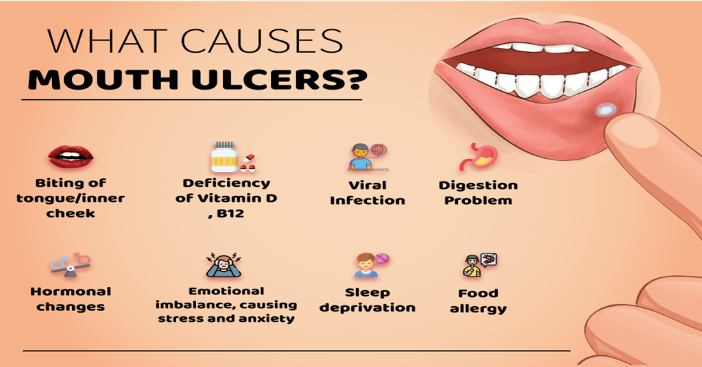 Mouth ulcers causes