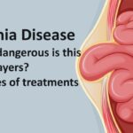 Hernia Disease-how dangerous is this disease for players?- 02 types of treatment