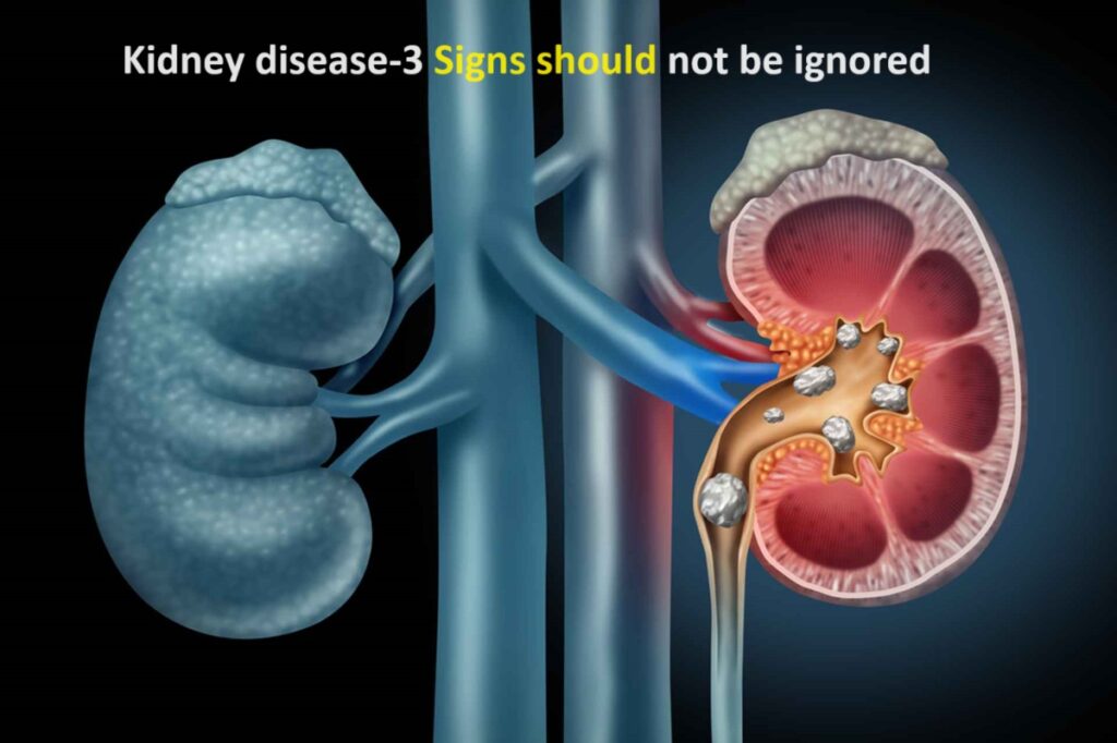 Kidney disease