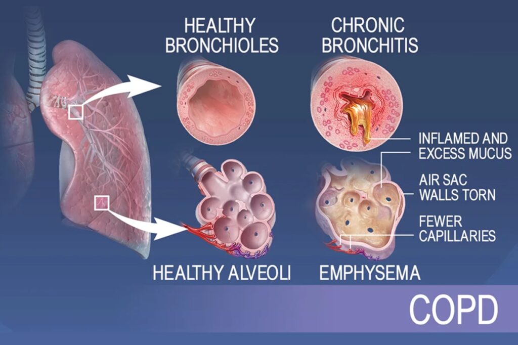 Lungs