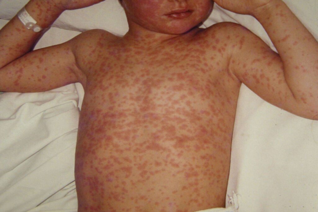 Measles