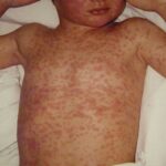 Measles