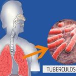 Tuberculosis