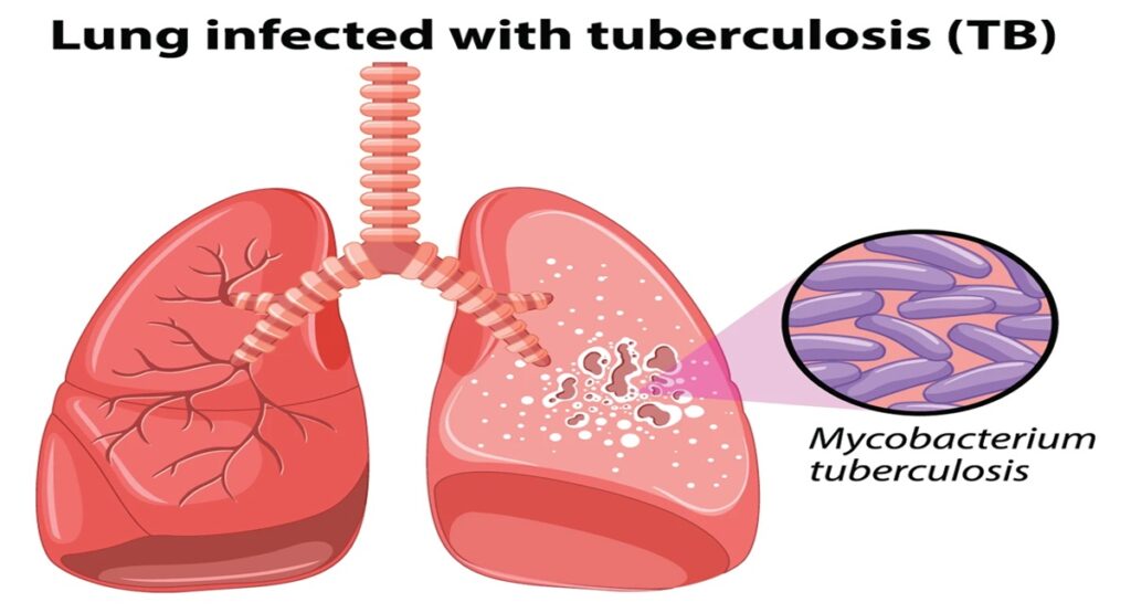 Tuberculosis