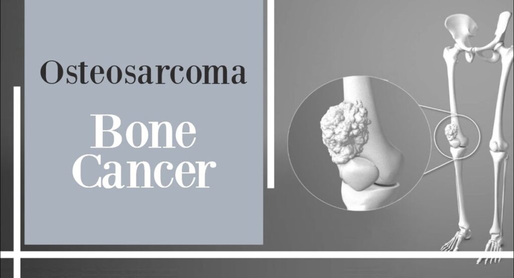 Osteosarcoma