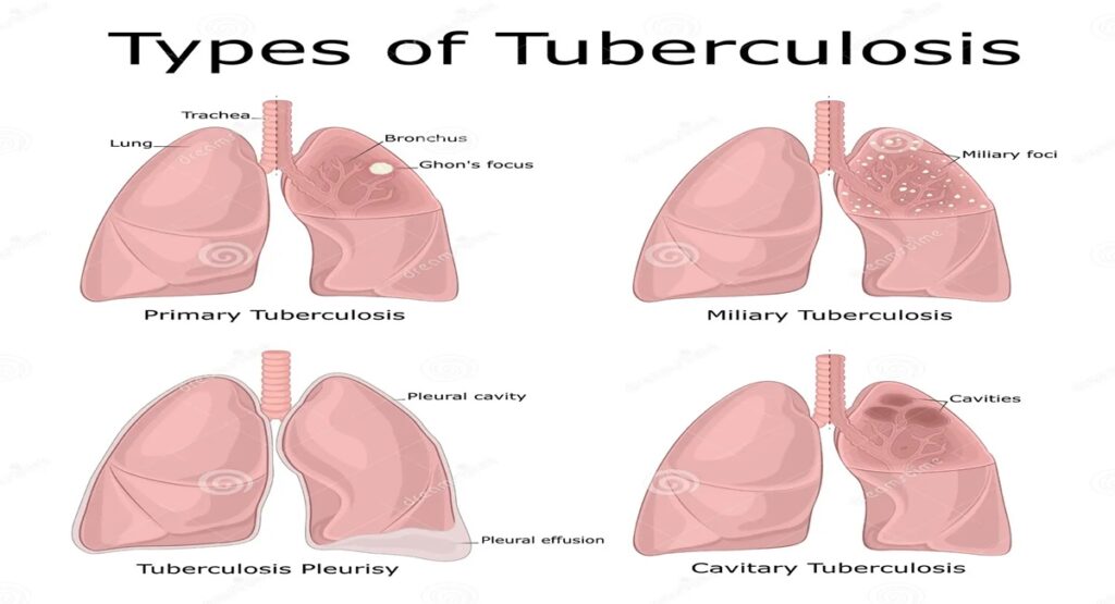 Tuberculosis