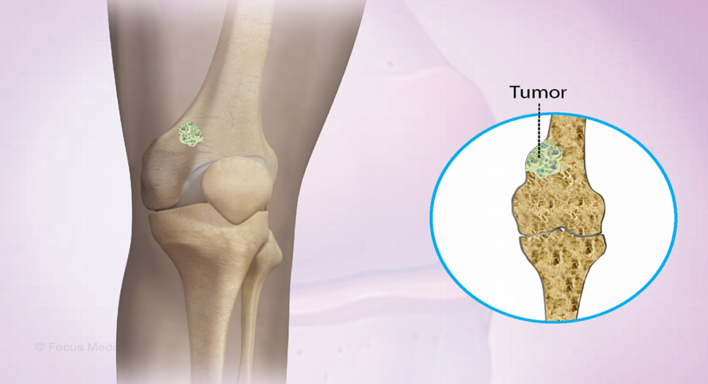 Osteosarcoma