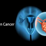 Ovarian Cancer