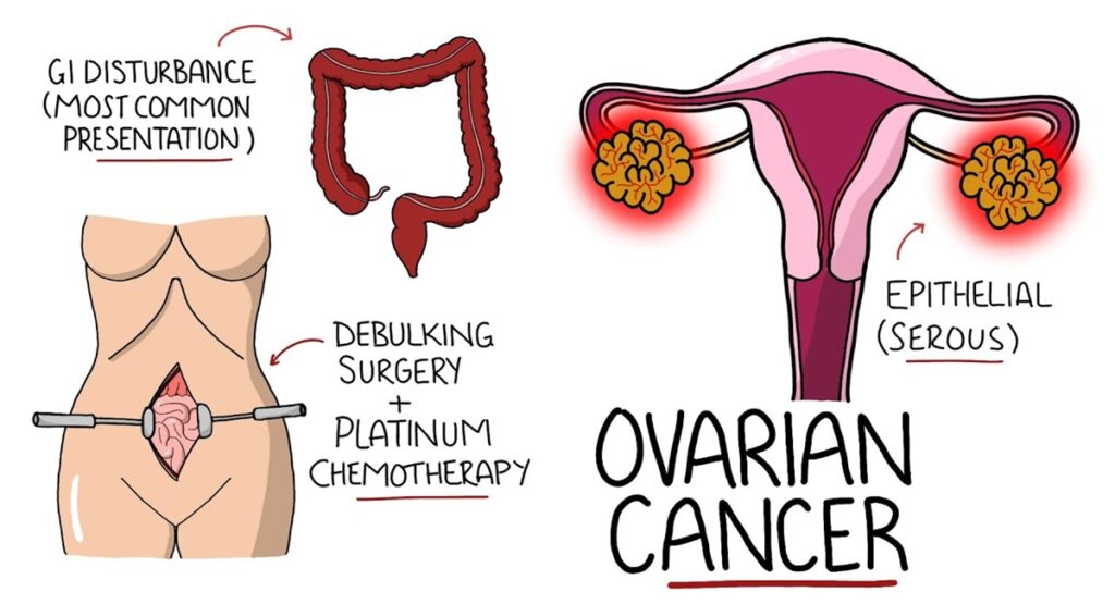 Ovarian Cancer